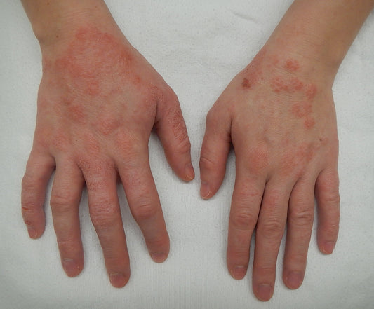 1 in 20 Children in Singapore have Atopic Eczema